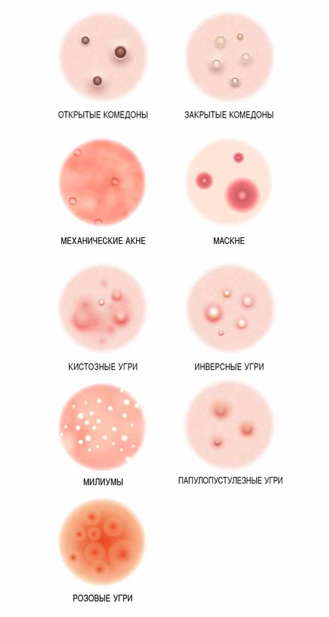 Препараты от угревой сыпи и акне