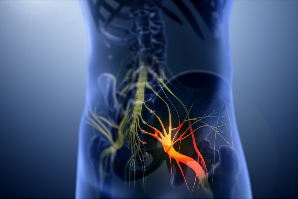  Защемление седалищного нерва (ишиас) – это боль, которая распространяется по ходу седалищного нерва. Седалищный нерв проходит от поясницы через бедра и ягодицы и вниз по каждой ноге.-2
