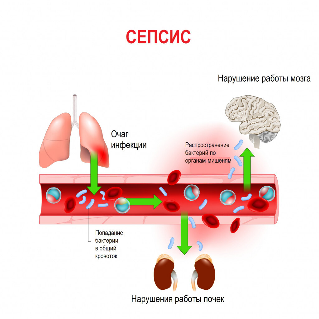 Сепсис | Просто о сложном (советы хирурга, травматолога-ортопеда) | Дзен
