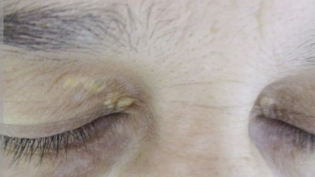 Стала обращать внимание, нередко встречаются люди, у кого есть такие образования на веках  