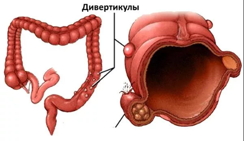 Дивертикул - выпячивание стенки кишки наружу с образованием своеобразного кармана, в который в итоге забивается пища. Дивертикул часто подвержен воспалению