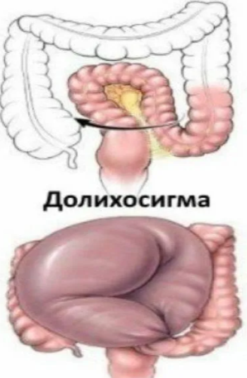 Долихосигма - удлинение сигмовидной кишки, часто с образованием дополнительных петель и расширением части кишки. Скопление каловых масс с большом объема тоже способствует возникновению запоров.