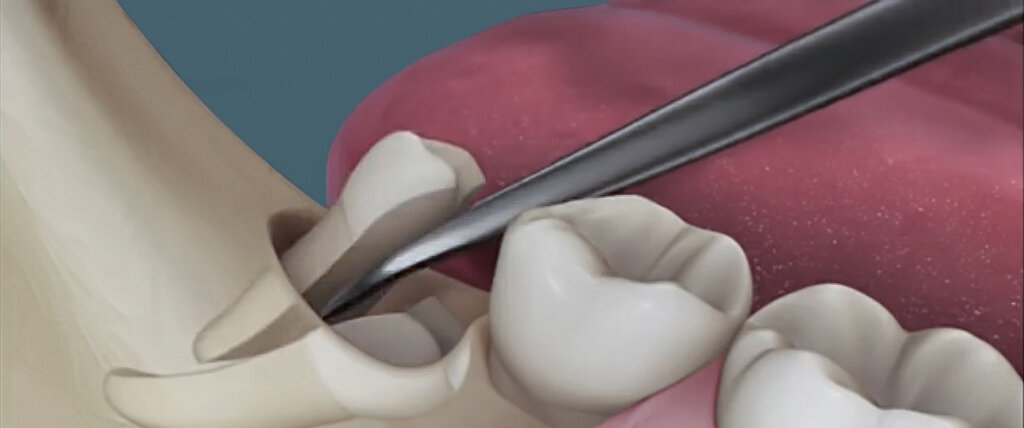 Зубы мудрости - оставлять или удалять? | Цифровая стоматология Денталь ...