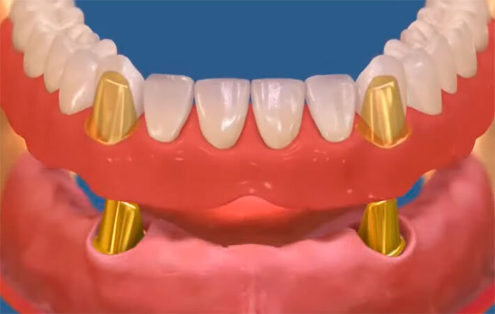 Несъемные зубные протезы - плюсы и минусы