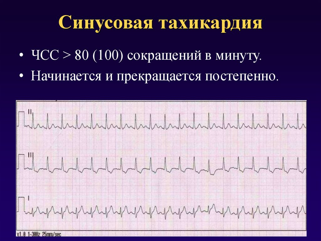Что значит синусовый ритм сердца на экг. Пароксизмальная синусовая тахикардия. ЭКГ тахикардия синусовый ритм. Синусовая тахикардия ЧСС 100 ЭКГ. Синусовый ритм ЧСС 100 уд/ мин тахикардия.