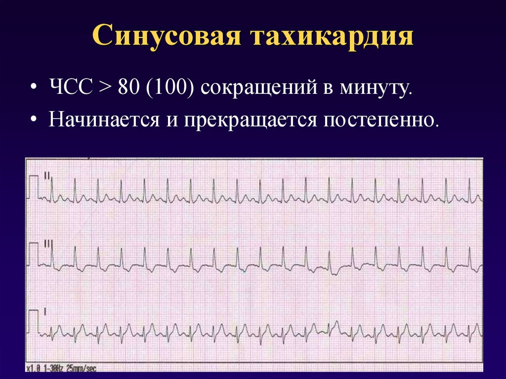 Синусная тахикардия это. Пароксизмальная синусовая тахикардия. Синусовая тахикардия ЧСС 100 ЭКГ. Синусовая тахикардия максимальная ЧСС. Синусовая тахикардия с ЧСС 170.