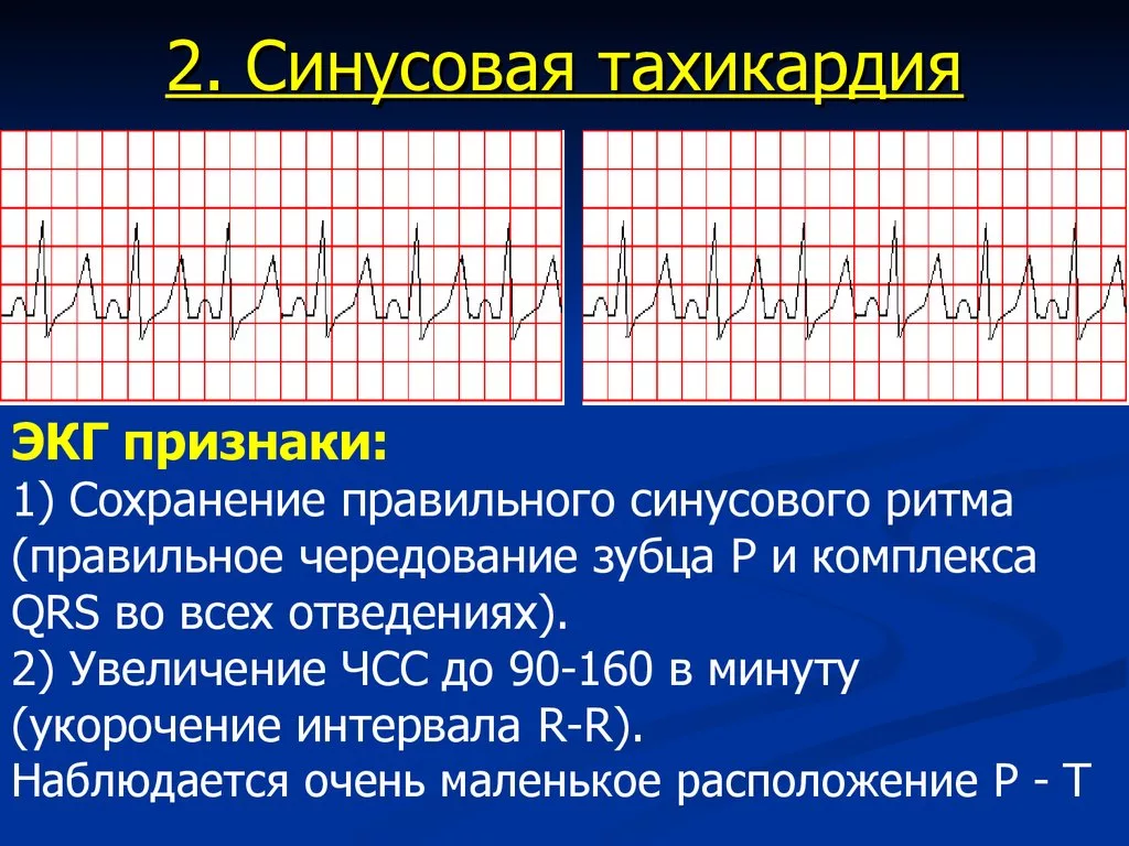 Синусовая тахикардия сердца у взрослых