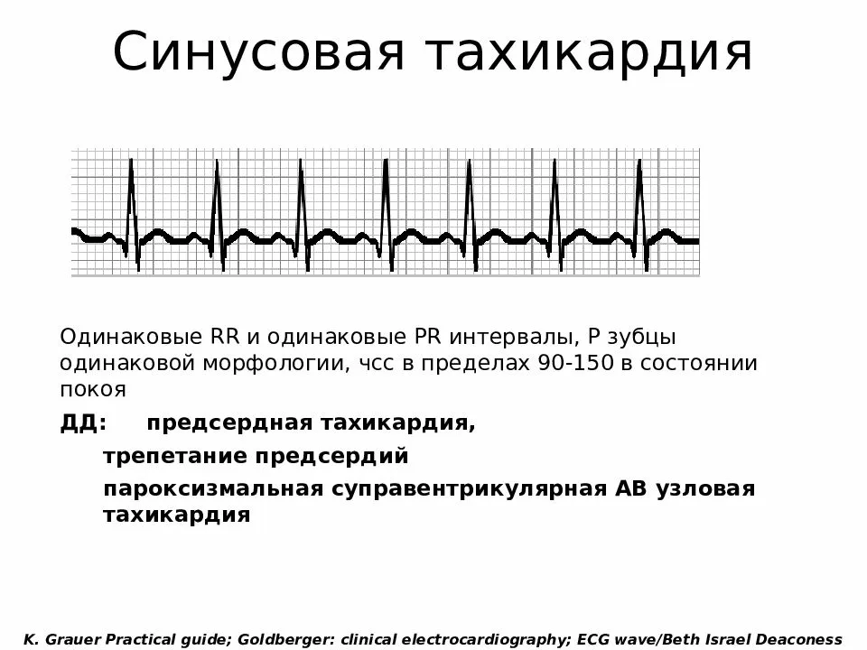 Симптомы тахикардии