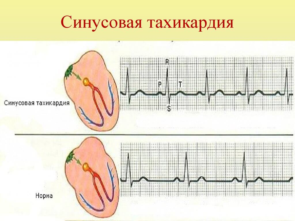 Тремор и тахикардия