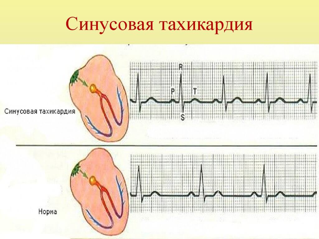 Тахикардия - причины, симптомы, лечение в ФНКЦ ФМБА