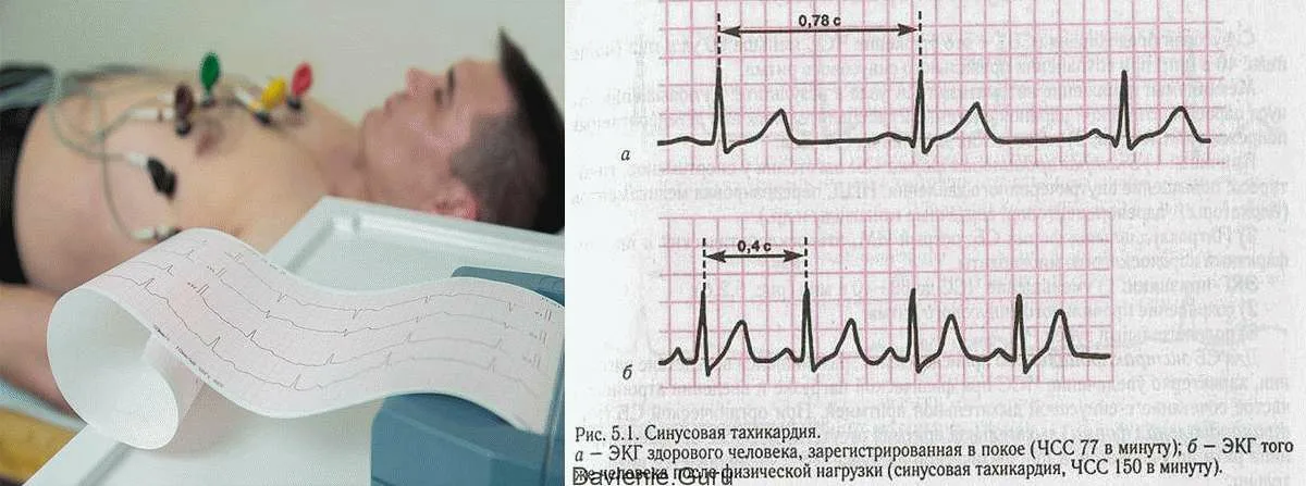 Тахикардия: причины, симптомы и лечение