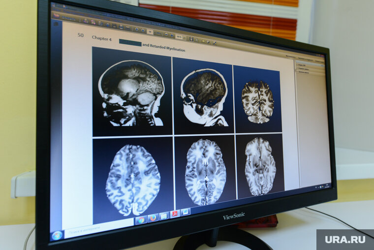    Женщине прооперировали уникальное кровоизлияние, которое произошло в пространстве между полушариями мозга