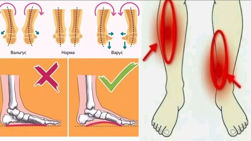 4 шага для укрепления стоп и голеностопов. Спасая малоберцово-таранную связку, спасая все суставы ног