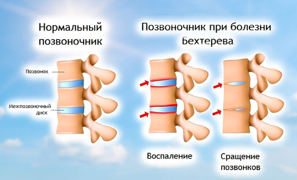 Что такое болезнь бехтерева простыми словами. Анкилозирующий спондилит болезнь Бехтерева. Анкилозирующий спондилез это болезнь Бехтерева. Срастание позвонков болезнь Бехтерева. Болезнь Бехтерева сращение.