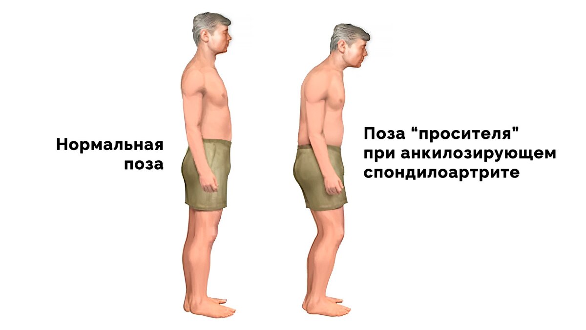 Болезнь бехтерева по наследству. Болезнь Бехтерева Штрюмпеля Мари. Болезнь Бехтерева клинические проявления. Болезнь Бехтерева у женщин. Болезнь Бехтерева симптом Кушелевского.