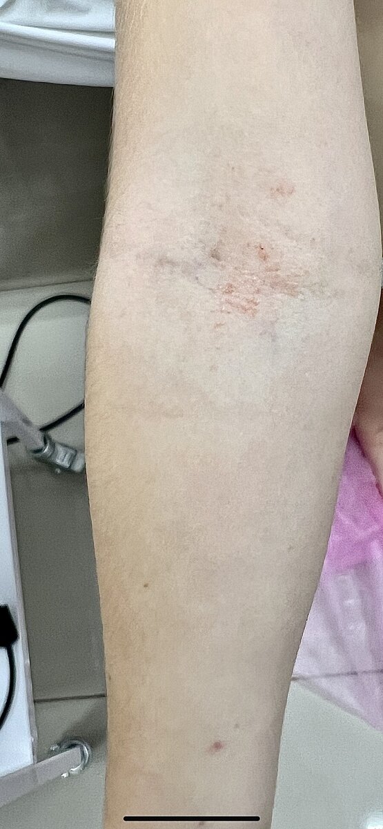 Фото из личного архива врача-дерматолога Тимачевой И.А. Высыпания у девочки-атопика в области локтевого сгиба представлены россыпью мелких папул цвета нормальной кожи с характерным перламутровым блеском, на фоне имеется эритема, которая возникла в результате постоянного расчесывания элементов. 