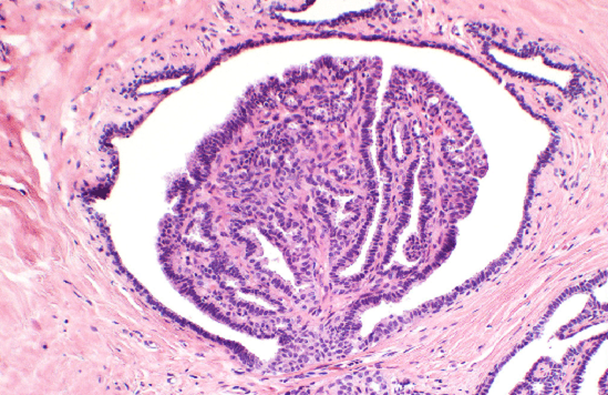 ВНУТРИПРОТОКОВАЯ ПАПИЛЛОМА МОЛОЧНОЙ ЖЕЛЕЗЫ | Онкология понятным языком ...