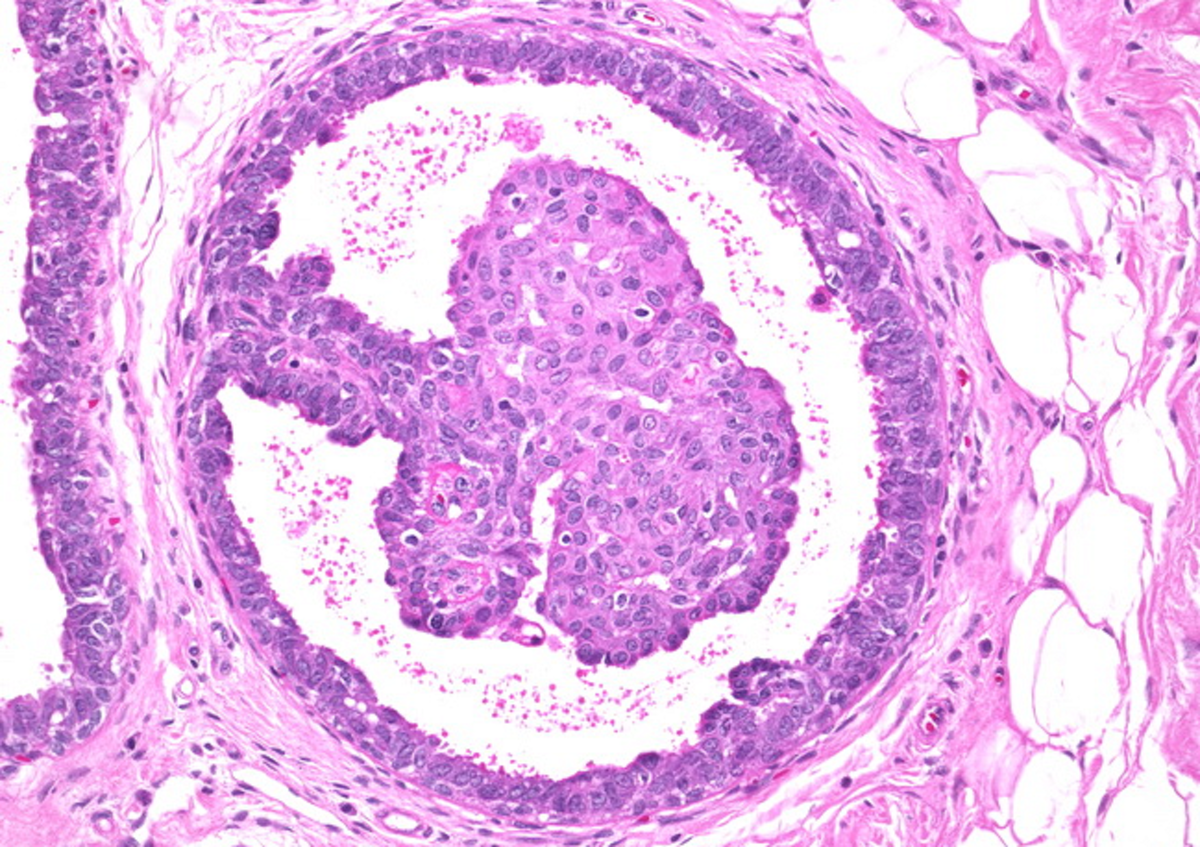Предстательная железа дисплазия. Внутрипротоковая папиллома гистология. Фиброзно-кистозная мастопатия гистология. Внутрипротоковая папиллома молочной железы микропрепарат. Внутрипротоковая папиллома микропрепарат.