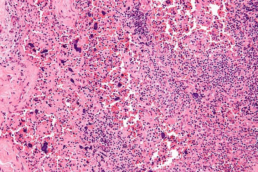 Изменения лимфатического узла, вызванные системной красной волчанкой Фото: wikipedia.org