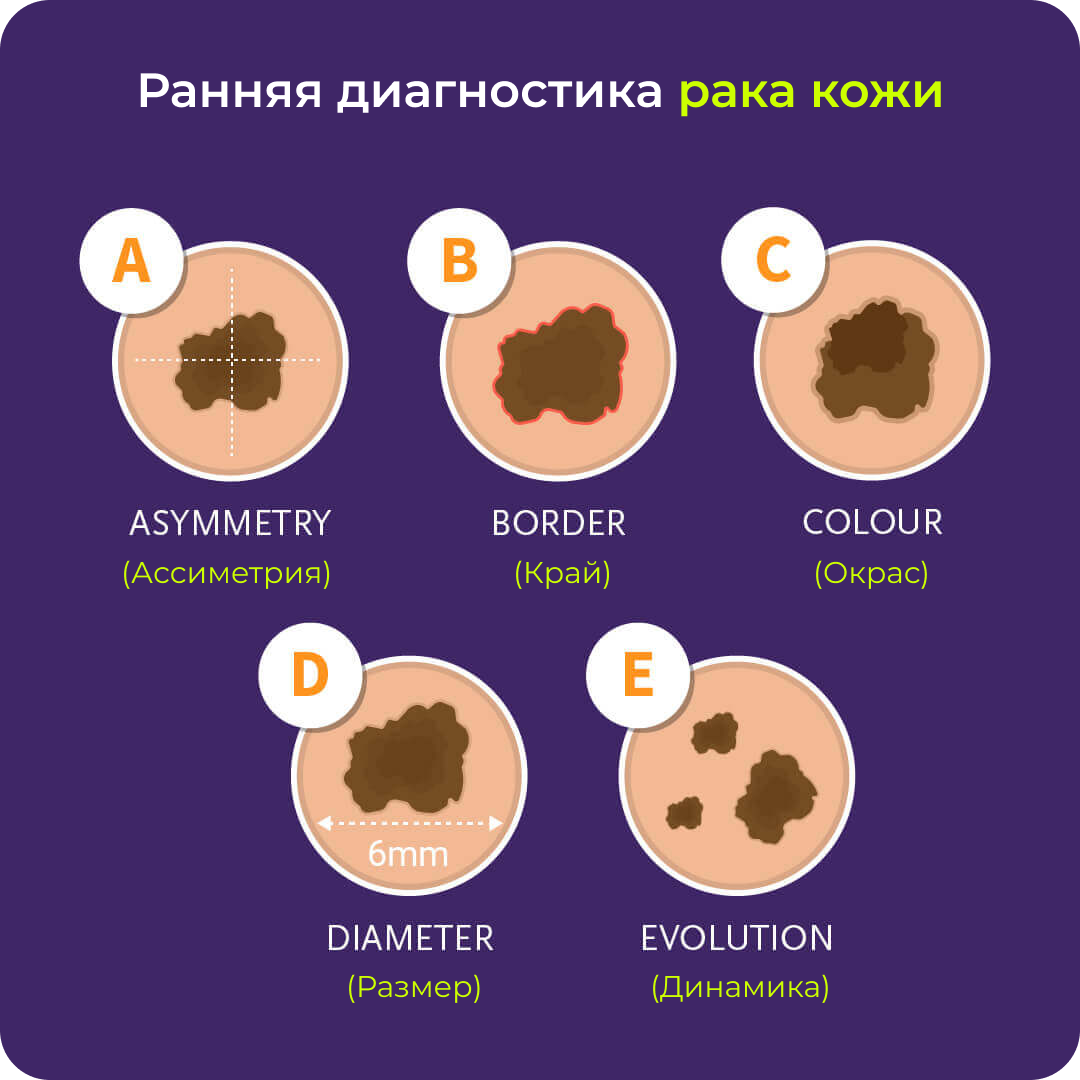 Ранняя диагностика рака кожи