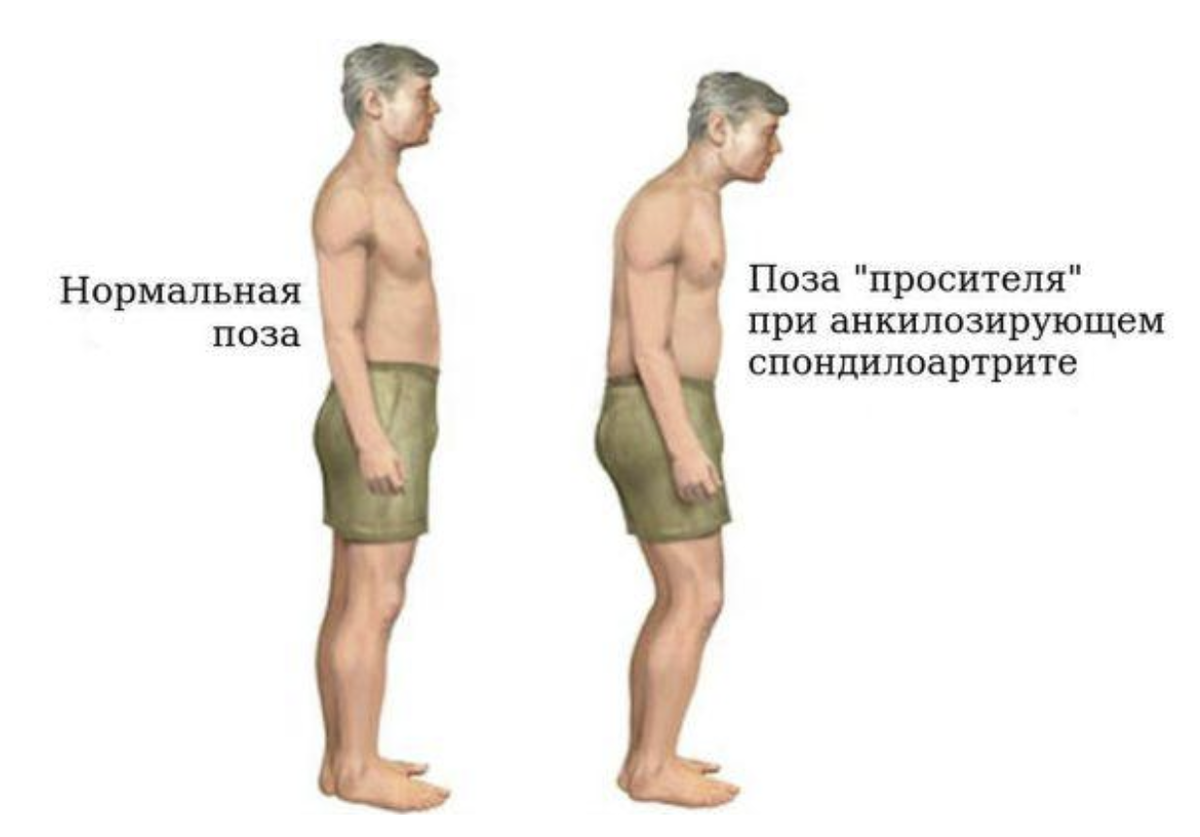 Это ещё не самый запущенный вариант. Источник - https://www.centr-med.ru/stati/posledstvija-bolezni-behtereva/