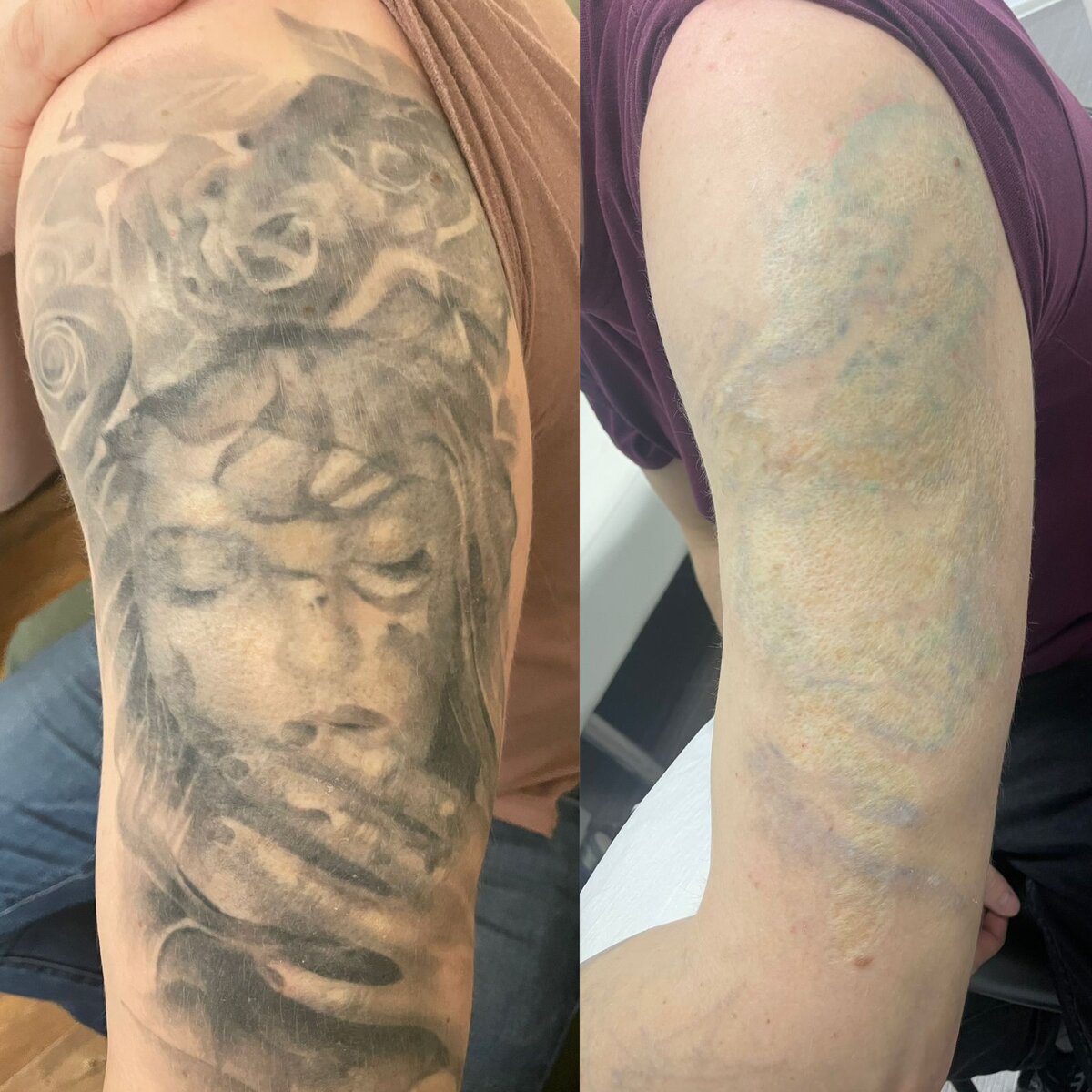 Результат удаления тату лазером