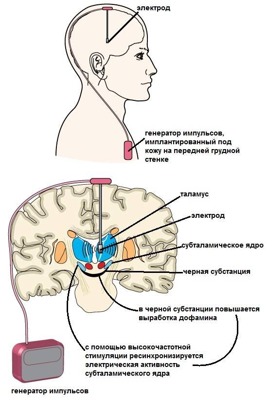 Схема глубокой стимуляции мозга. Фото с портала http://junisa.ru/