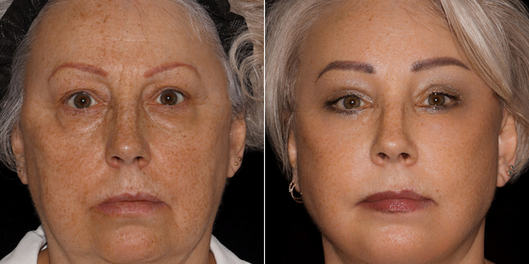 Deep Plane Facelift - новый в России метод омоложения лица. Почему это лучше классической SMAS-подтяжки?