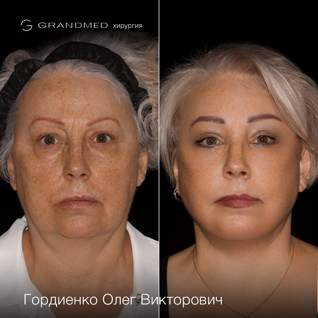 Deep plane facelift отзывы