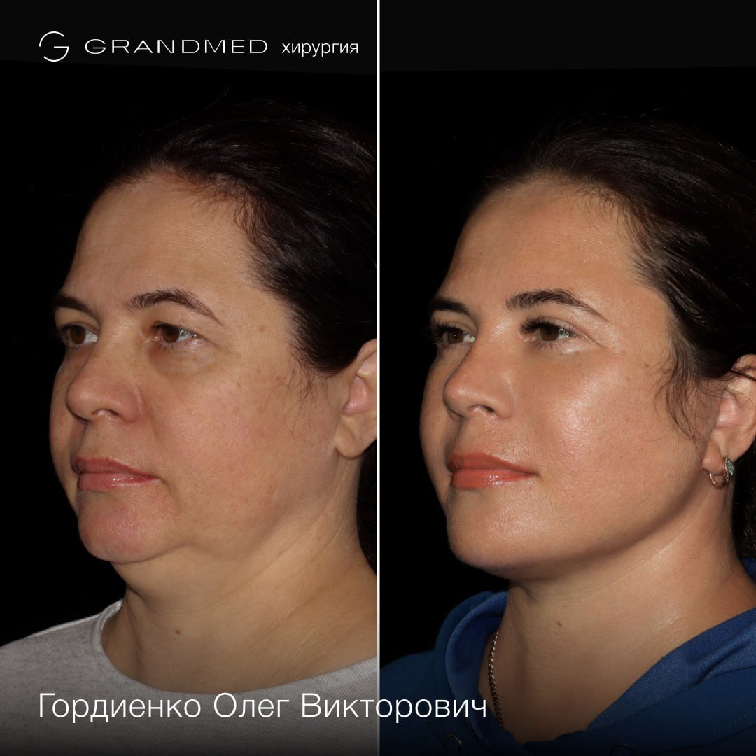 Пациентке я выполнил комплексное омоложение лица по методике Deep Plane FaceLift. Имеются противопоказания, необходима консультация специалиста