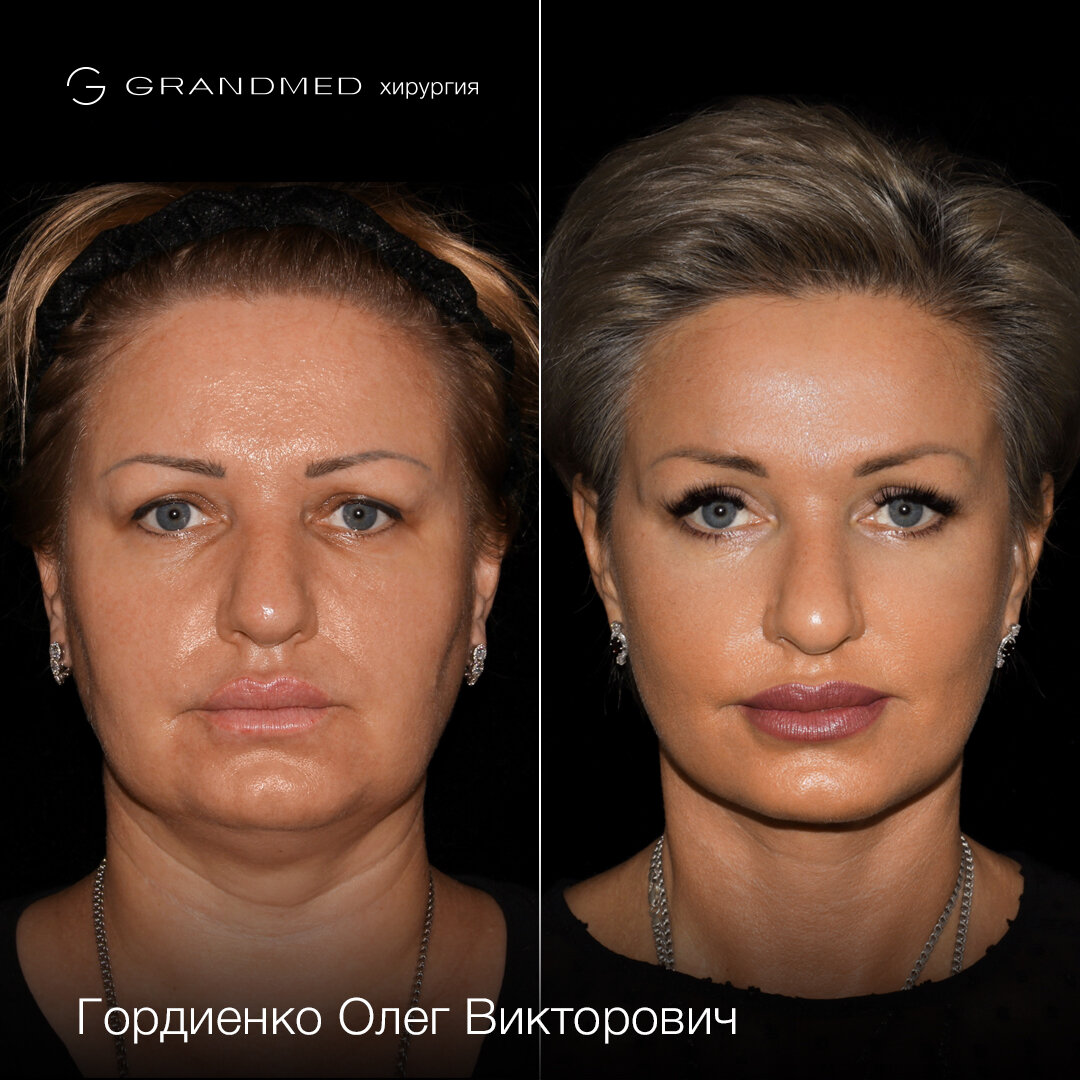 Deep plane facelift отзывы