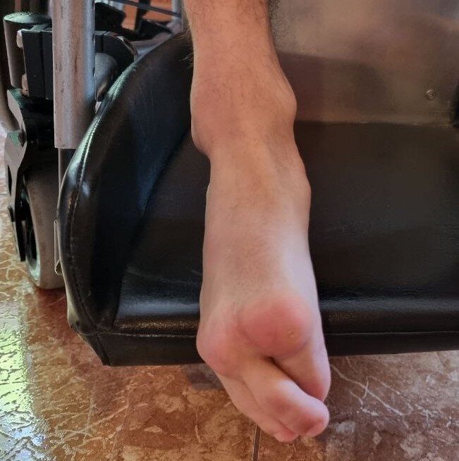 Спастика делает своё чёрное дело годами. Разминай — не разминай, рано или поздно, но оперировать придётся.