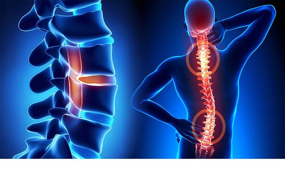 Центр здоровья позвоночника. Позвоночник. Остеохондроз. Остеохондроз позвоночника. Остеохондроз спины.