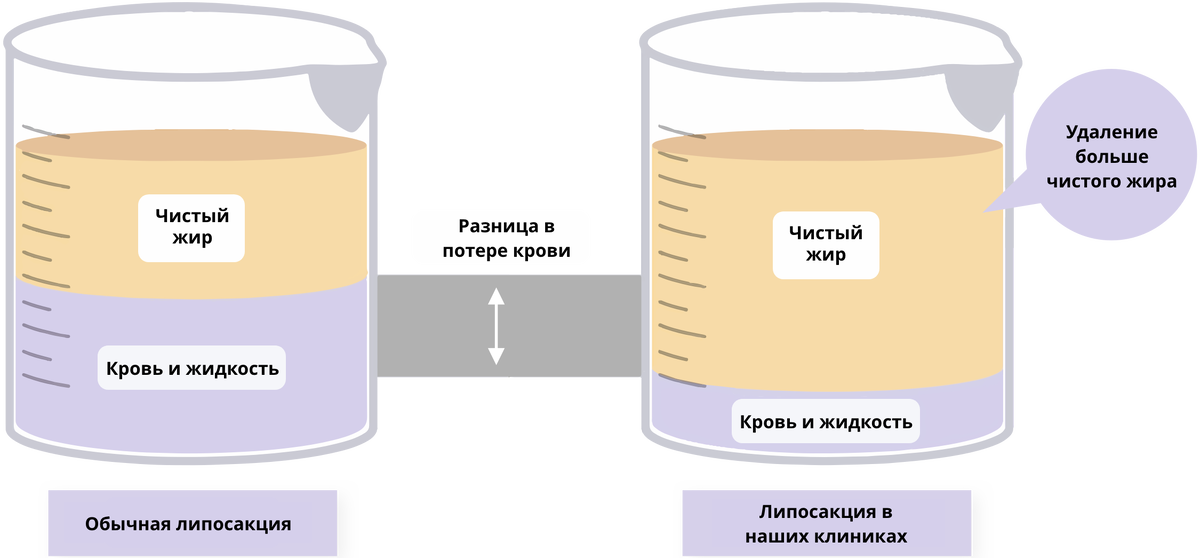 Разница между обычной липосакцией и липосакцией, проводимой в наших клиниках