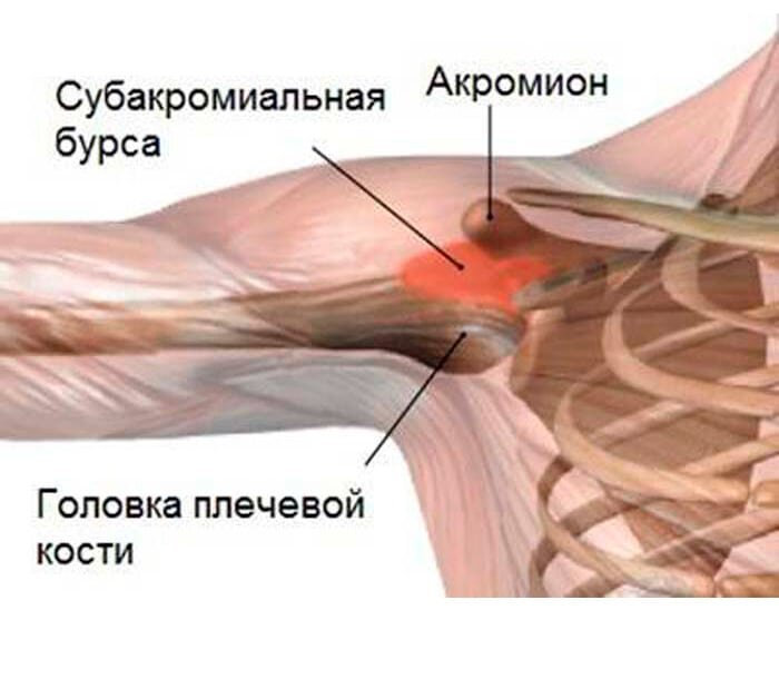 Плечелопаточный периартрит - причины, симптомы и лечение