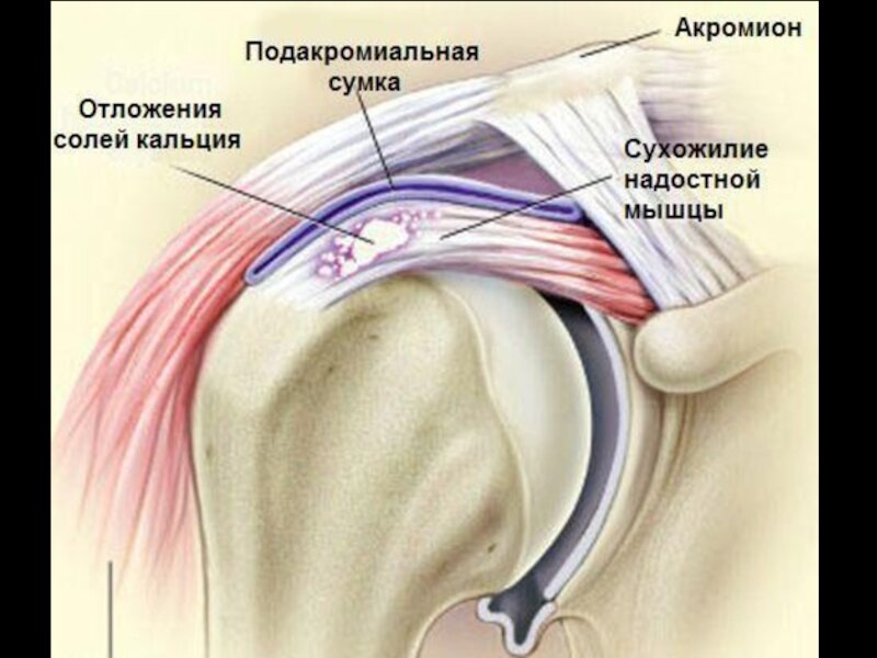 Тендинит плечевого сустава