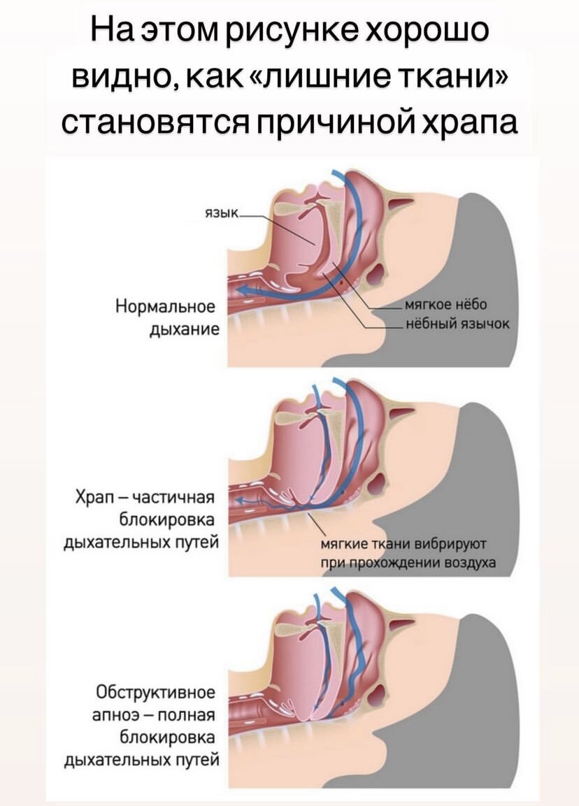 Храп 4. Человек храпит во сне. Человек храпит. Храп 4. Муж храпит.