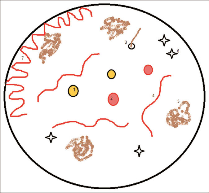 Рис.1. Дерматоскопические признаки дискоидной красной волчанки. (1) фолликулярные пробки, (2) фолликулярные красные точки, (3) перифолликулярный беловатый ореол, (4) линейные кровеносные сосуды, (5) пигментация, (6) розетки и (7) паттерн звездной вспышки.
Первоисточник - Fathy H, Ghanim BM, Refat S, Awad A. Dermoscopic criteria of discoid lupus erythematosus: An observational cross-sectional study of 28 patients. Indian J Dermatol Venereol Leprol. 2022 May-Jun;88(3):360-366 
Dermoscopic criteria of discoid lupus erythematosus: An observational cross-sectional study of 28 patients - PubMed (nih.gov)