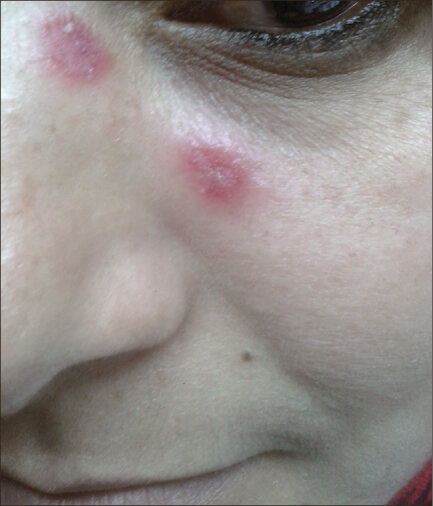 Рис. 2a. Свежий очаг поражения ДКВ на коже лица.
Первоисточник - Fathy H, Ghanim BM, Refat S, Awad A. Dermoscopic criteria of discoid lupus erythematosus: An observational cross-sectional study of 28 patients. Indian J Dermatol Venereol Leprol. 2022 May-Jun;88(3):360-366 
Dermoscopic criteria of discoid lupus erythematosus: An observational cross-sectional study of 28 patients - PubMed (nih.gov)