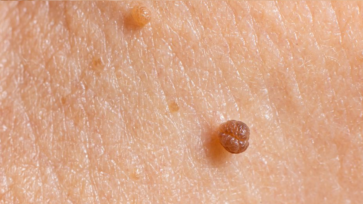 От каких новообразований на коже лучше избавиться? | Дерматолог Ольга ...