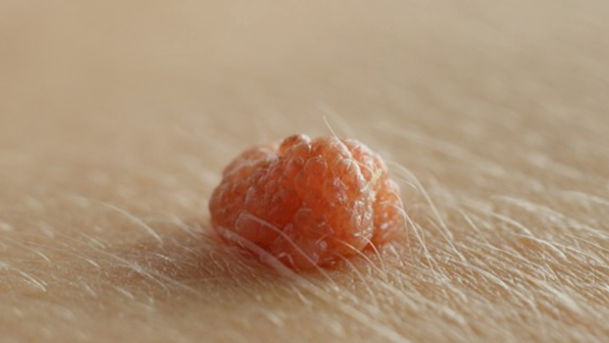 Warts are no fun! Use vinegar to remove them Essential oils, Warts, Tea tree ess