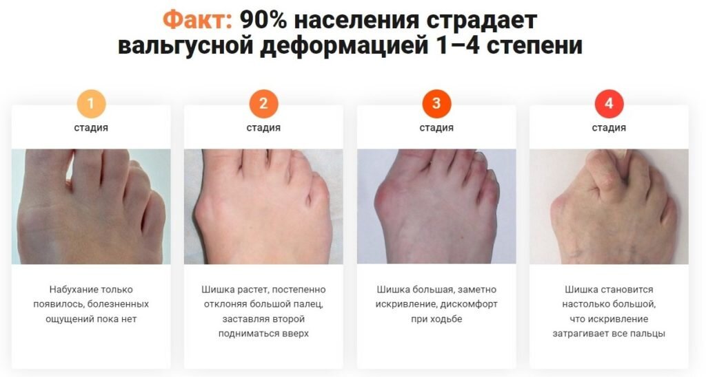 Вальгус стадии фото