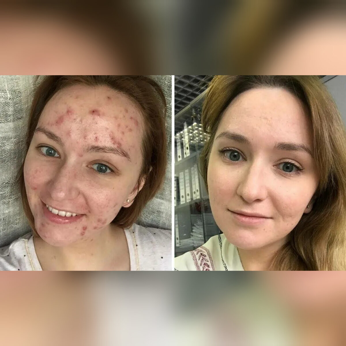 Избавление от прыщей.