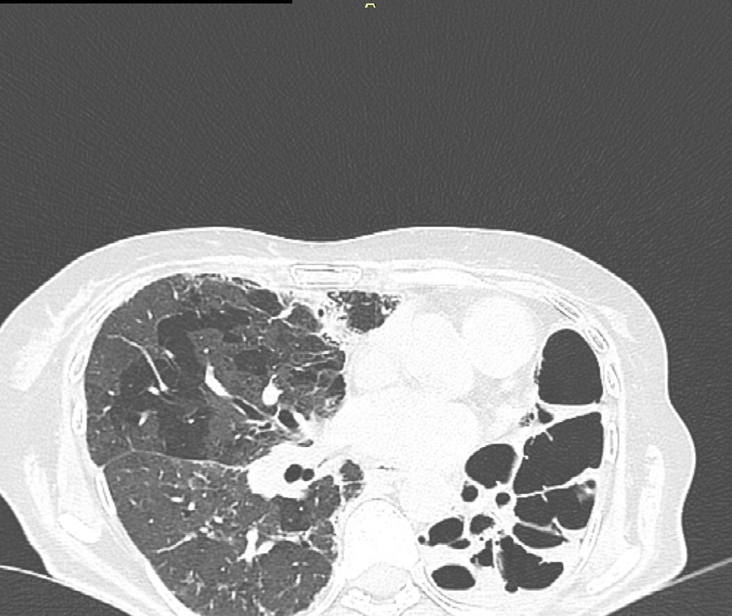 Снимок из серии КТ с диска. Мои лёгкие.