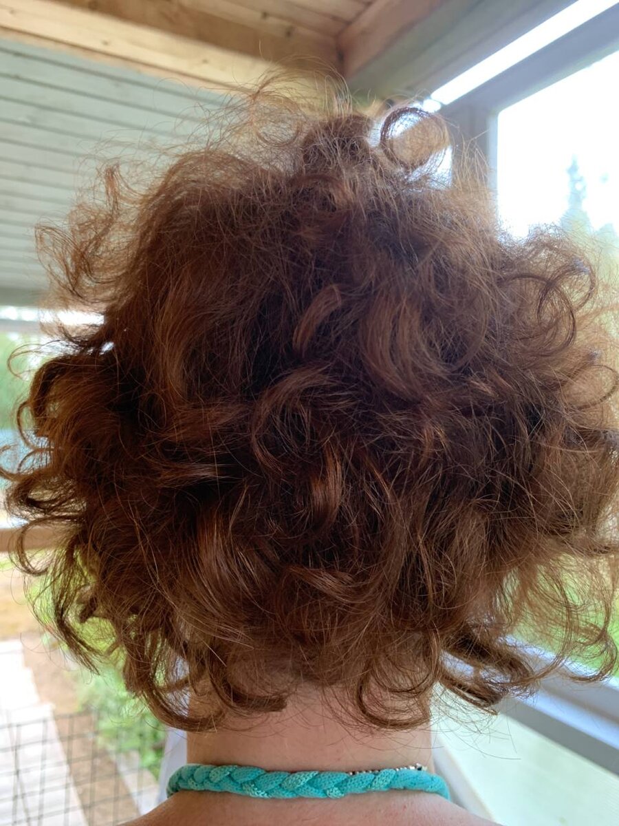 Так выглядела моя голова через 8 месяцев после операции.