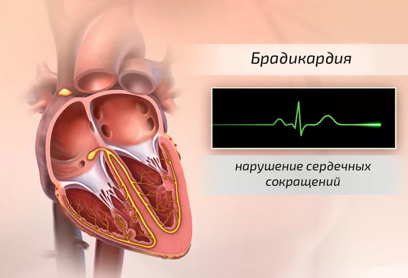 Брадикардия - Справочник заболеваний