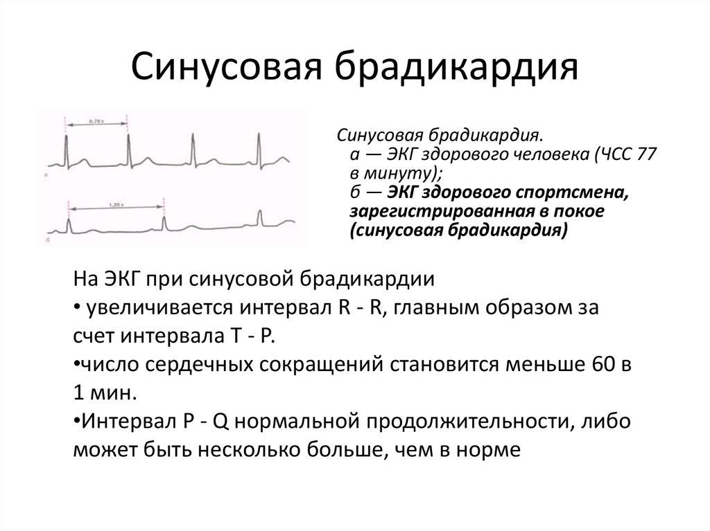 Аритмия норма пульса