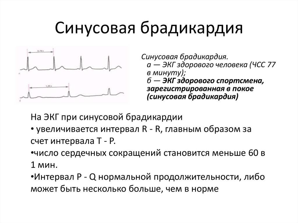 Брадикардия симптомы, диагностика, лечение