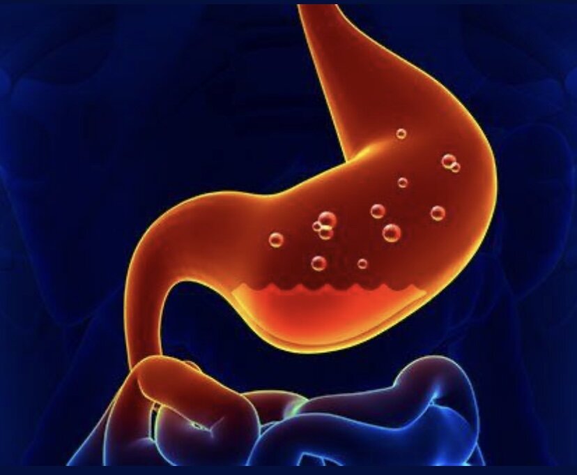 Гастрит - многим знакомое с детства слово и вроде как, есть почти у всех. 
Так ли это ? Давайте разбираться.

Хронический гастрит, действительно, одно из самых распространённых заболеваний ЖКТ. 

🩺 Может протекать бессимптомно. 
Диспепсические проявления при гастрите проявляются в виде раннего насыщения, тошноты, боли/тяжести в эпигастрии и/или чувства жжения. 
Обычно, симптомы возникают до приёма пищи, или в течение 1-2 часов после. 

Самые частые причины гастрита:

🔸инфицирование бактерией Helicobacter pylori 
🔸длительный приём нестероидных противовоспалительных средств (аспирин, парацетамол и тд)
🔸вследствие дуоденогастрального рефлюкса
🔸аутоиммунный атрофический гастрит 

❗️Внимание❗️Доказано, что бактерия Хеликобактер при отсутствии лечения способствует развитию атрофии слизистой,  метаплазии, и, как следствие, дисплазии - а это уже состояния, при которых значительно возрастает риск рака желудка. 

Подтвердить диагноз «хронический гастрит»можно только при проведении гистологического исследования биоптата (кусочка ткани слизистой желудка) взятого при эндоскопическом исследовании желудка.

