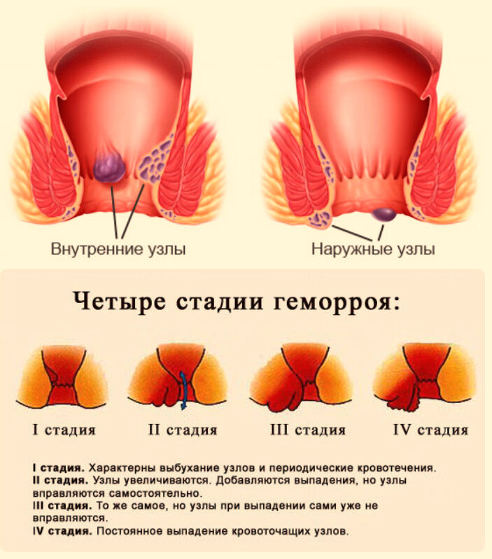 Как выглядит здоровый геморрой